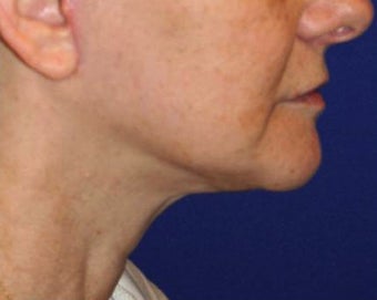 Neck lift surgery after 526353