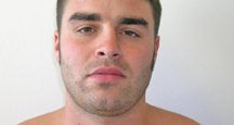 Chin Liposuction before 490757
