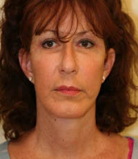 Face and Necklift, Eyelids, Temporal Browlift after 232351