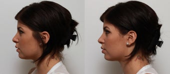 Non Surgical Nose Job Rhinoplasty 553496