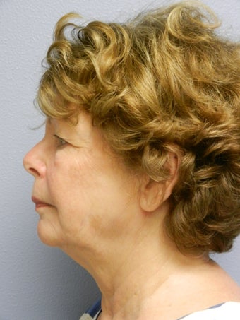 Lower Face with Neck Lift 598901