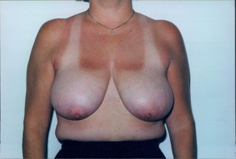Breast Reduction before 218953