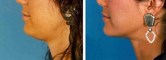 Chin Liposuction before 640723