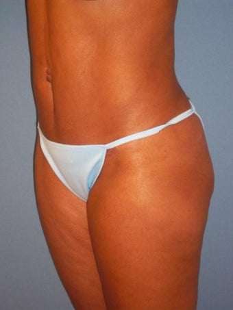 Mini Tummy Tuck after 346173