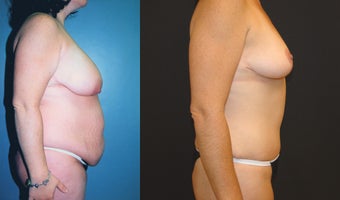 Breast Lift, Tummy Tuck and Liposuction before 350986
