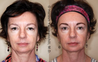 Sculptra before 460382