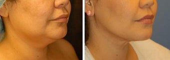 Chin Liposuction before 640729