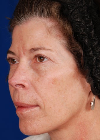 Radiesse Cheek Augmentation before 263002