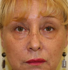 blepharoplasty (eyelids) before 219354