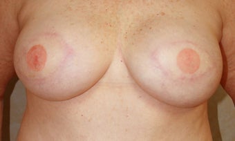 Breast Reconstruction after 517501