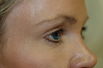 Forehead Lift 434857