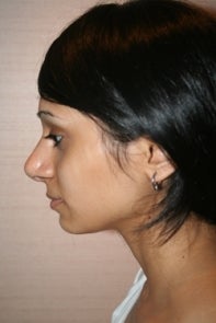 Asian Rhinoplasty 448668