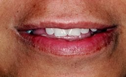 Dental Implants before 262214