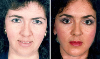 Cheek Lift and Augmentation before 296656