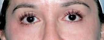 Latisse for Eyelashes after 374415