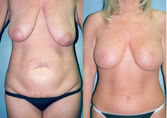 Tummy Tuck + Liposuction + Breast Lift + Implants before 350996
