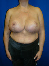 Surgery After Massive Weight Loss after 131829