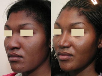 African American Rhinoplasty after 137748
