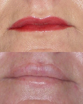 Lip Lift before 366821