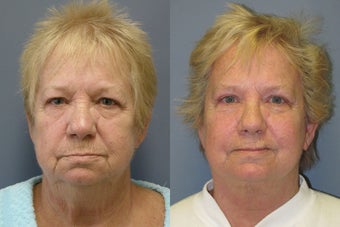Lite Lift™, liposuction of the neck, brow lift, eyelid lift after 523711