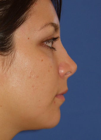 Revision Rhinoplasty 410615