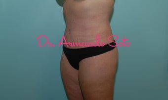 Body Lift after Large Weight Loss after 534126