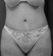 Tummy Tuck, Liposuction after 402480