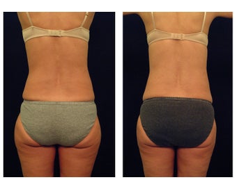 Liposuction after 397030