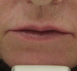 63 year old lip Augmentation with Juvederm after 53008