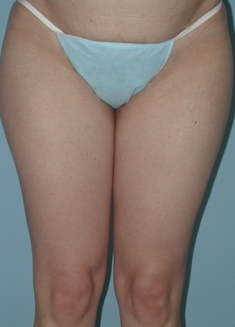 Thigh Lift before 230716