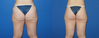 Body Lift before 283419