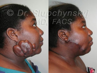Keloid Removal 548814