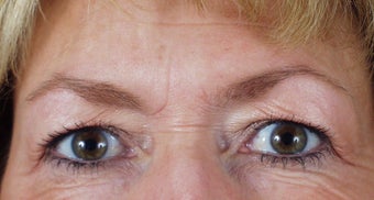 Endoscopic brow lift and blepharoplasty before 240871