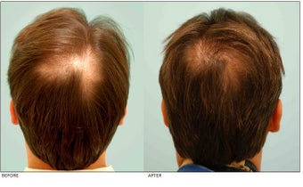 Crown (Vertex) Hair Transplant before 134769