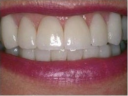 Smile Makeover Treatment after 430545