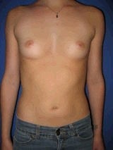 Breast Augmentation Surgery before 143996