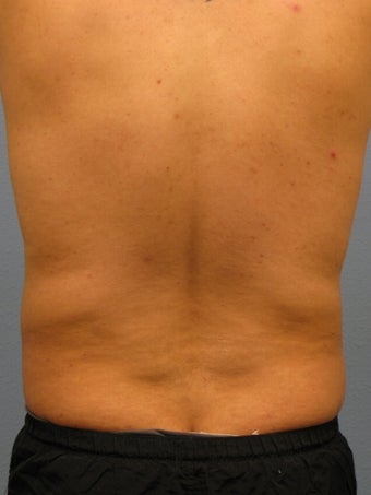 Liposuction Male 575522