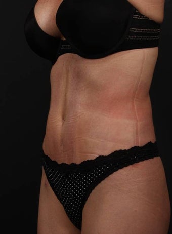 Abdominoplasty 398183
