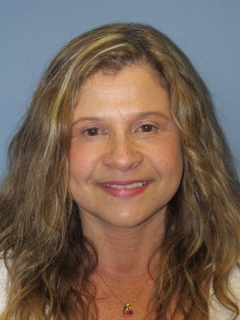 Neck Lift, Platysmaplasty after 634725