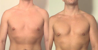Pectoral implants before 161537