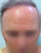 BHT – SFET Using Only Body Hair before 196027