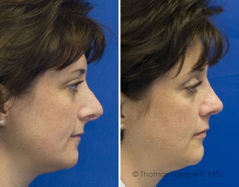 Revision Rhinoplasty after 236699