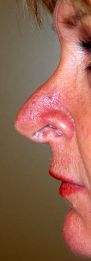 Revision Rhinoplasty before 578318