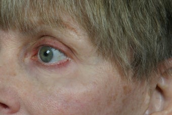 Botox after 309232