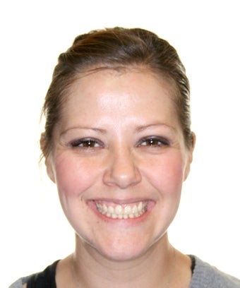 Surgical Orthodontics after 344747