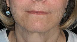 "Liquid face lift" after 374978
