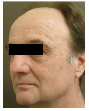 Pixel laser before 177818
