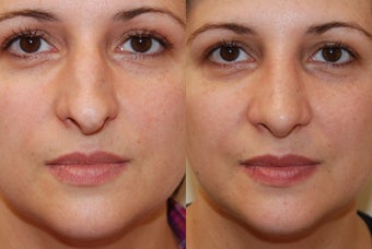 Rhinoplasty, 3 weeks post-op. Front view before 139109
