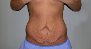 Abdominoplasty before 486527