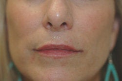 Restylane Treatment for lips after 91062